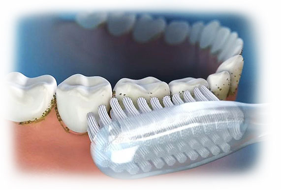 Причины образования зубного камня и способы его профилактики