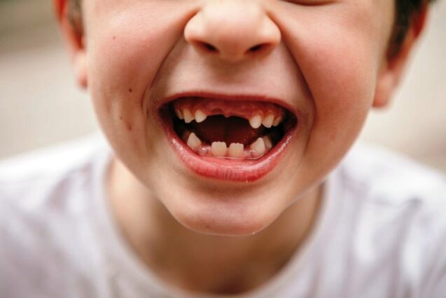Каковы причины выпадения зубов?